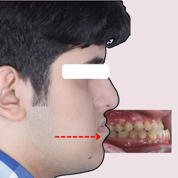 نیم رخ صورت و اکلوژن دهان بیمار با کلاس سه (Class III) و آندربایت (Underbite) قبل از درمان ارتودنسی