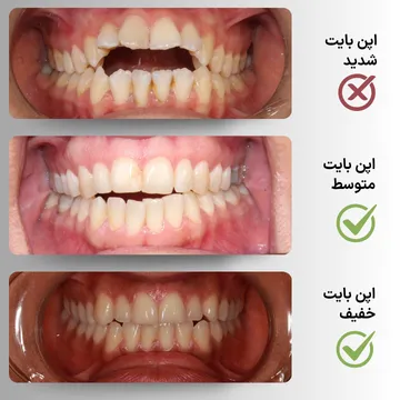 سه نمای داخل دهان از اپن بایت (Open Bite) خفیف، متوسط و شدید از خط میانی قبل از درمان