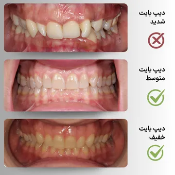 سه نمای داخل دهان از دیپ بایت (Deep Bite) خفیف، متوسط و شدید از خط میانی قبل از درمان