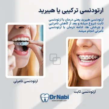 نما لبخند با ارتودنسی ثابت و نما لبخند با ارتودنسی نامرئی همراه با توضیح کوتاه ارتودنسی هیبرید در بک تصویر