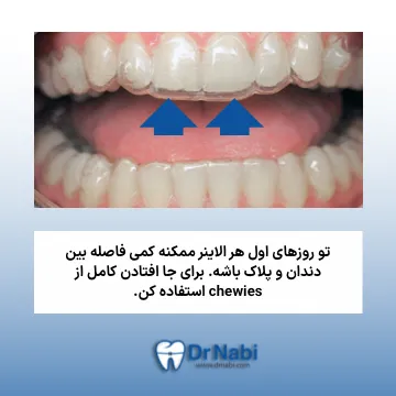 روش درست جا زدن الاینر شفاف روی دندان ها