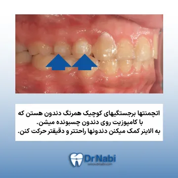 روش خارج کردن الاینر از دندان های عقب به جلو