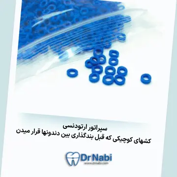 سپراتور ارتودنسی ثابت تصویر سپراتورهای آبی ارتودنسی ثابت با توضیح کامل به صورت متن
