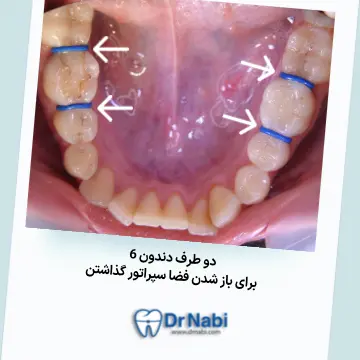 سپراتورهای ارتودنسی ثابت بین دندانها تصویر سپراتورهای ارتودنسی ثابت دو طرف دندانهای 6 فک پایین با توضیح کامل به صورت متن