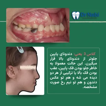 کلاس 3 فک پایین در کودکان نمای داخل دهان و نیم رخ کودک با جلو بودن فک پایین در کلاس 3