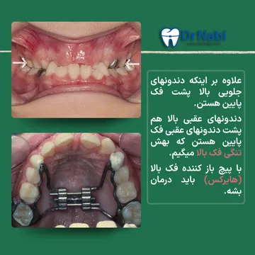 هایرکس در درمان تنگی فک بالای کودک نمای داخل دهان کودک دارای تنگی فک بالا و دستگاه هایرکس