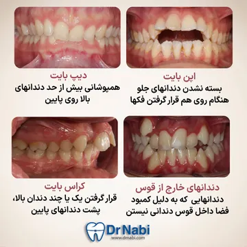 انواع ناهنجاری شدید دندانی یپ بایت، اپن بایت، کراس بایت، دندان خارج از قوس از بیماران دکتر نبی با توضیح در یک تصویر