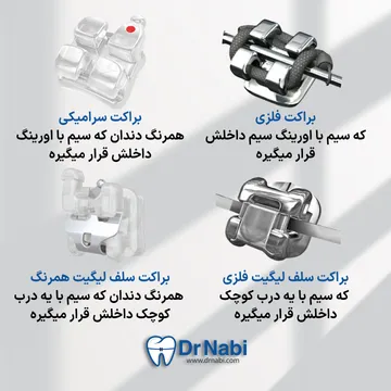 انواع براکت- فلزی، سرامیکی، سلف فلزی، سلف همرنگ در یک تصویر