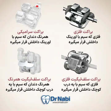 انواع براکت ارتودنسی ثابت انواع براکت- فلزی، سرامیکی، سلف لیگیتینگ فلزی، سلف لیگیتینگ همرنگ با توضیح کامل در یک تصویر