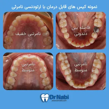 نمونه کیسهای مناسب ارتودنسی نامرئی در نامرتبی خفیف تا متوسط