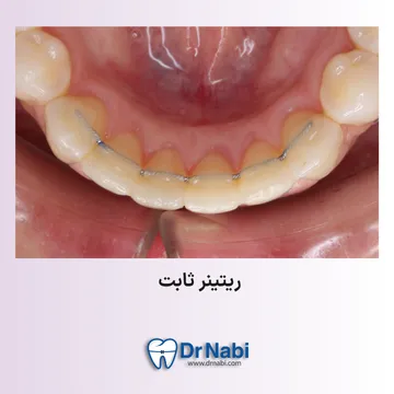 ریتینر ثابت پشت دندان های جلوی فک پایین