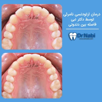 مقایسه قبل و بعد درمان ارتودنسی نامرئی در بیمار با فاصله بین دندونها شامل نمای اکلوزال بالا - توسط دکتر نبی