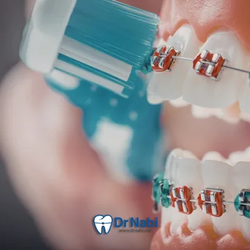  با مسواک ارتودنسی مستقیم روی سطح براکت ها تمیز میشه
