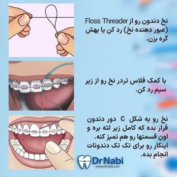 عبور دادن نخ با فلاس تردر از زیر سیم و تمیز کردن فضای بین دندان ها 