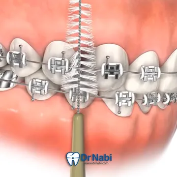 وارد کردن مسواک بین دندانی بین براکت ها برای حذف پلاک و خرده غذا