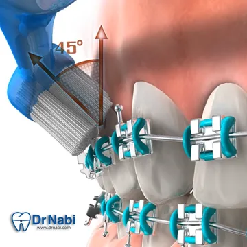 مسواک زدن دندان های دارای براکت با زاویه 45 درجه برای تمیز کردن لبه لثه و زیر سیم