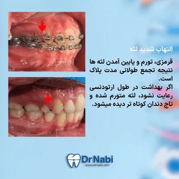 لثه قرمز و متورم اطراف براکت به دلیل تجمع پلاک