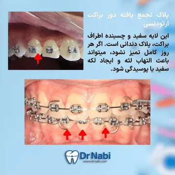 پلاک میکروبی تجمع یافته دور براکت ها و التهاب لثه ناشی از آن