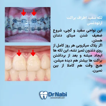 ضایعه سفید گچی روی مینای دندان ناشی از دمینرالیزاسیون در ارتودنسی