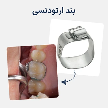بند ارتودنسی فلزی نصب شده روی دندان آسیاب برای نگهداری برخی دستگاه های ارتودنسی