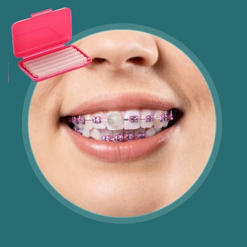 موم ارتودنسی روی براکت ها برای جلوگیری از زخم و تحریک لب و گونه