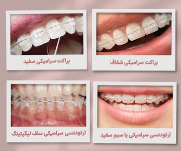 مقایسه انواع ارتودنسی سرامیکی شامل براکت سرامیکی شفاف، براکت همرنگ دندان، ارتودنسی سرامیکی با سیم سفید و براکت سرامیکی سلف لیگیتینگ
