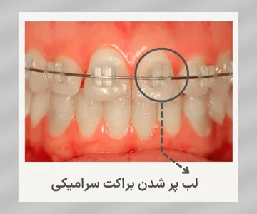 براکت سرامیکی ارتودنسی که دچار شکستگی یا لب پرشدگی شده و نیاز به بررسی و تعویض توسط متخصص ارتودنسی دارد.