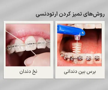 تمیز کردن براکت ارتودنسی با سوپرفلاس و برس بین دندانی برای حفظ بهداشت دهان و دندان