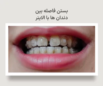 بیماری با فاصله بین دندان های جلویی که از الاینر شفاف برای درمان دیاستم و بستن فاصله بین دندان ها استفاده می کند.