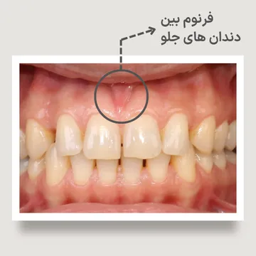 تصویر فرنوم لب بالا که با فلش مشخص شده است؛ فرنوم ضخیم یا با اتصال پایین می تواند یکی از عوامل ایجاد یا حفظ فاصله بین دندان های جلویی (دیاستم) باشد.