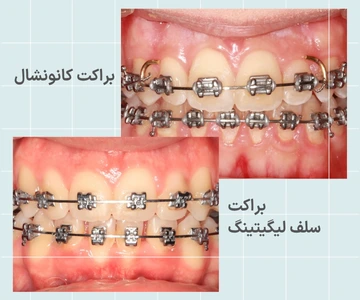 مقایسه براکت فلزی کانونشنال و سلف لیگیتینگ از نظر ساختار و نحوه نگهداری سیم ارتودنسی