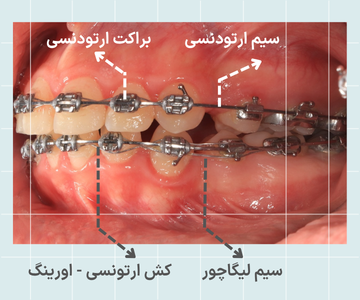 تصویر اجزای ارتودنسی فلزی شامل براکت سیم ارتودنسی و اورینگ روی دندان