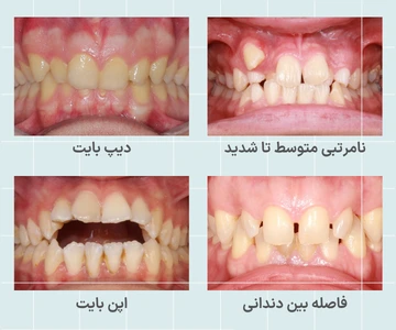تصویر ناهنجاری های قابل درمان با ارتودنسی فلزی شامل شلوغی دندان دیپ بایت اپن بایت و فاصله بین دندان ها