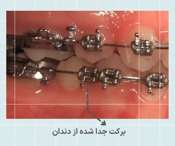 براکت ارتودنسی فلزی جدا شده از دندان که روی سیم باقی مانده و نیاز به مراجعه به متخصص دارد