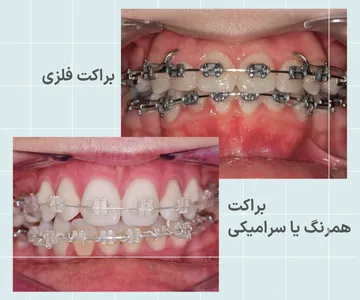 مقایسه ظاهری ارتودنسی فلزی و ارتودنسی سرامیکی از نظر رنگ براکت و میزان دیده شدن روی دندان