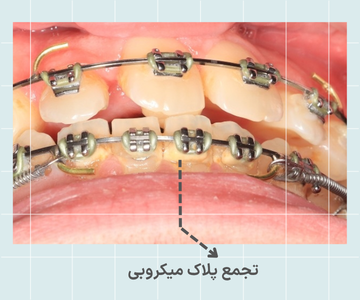 تجمع پلاک میکروبی اطراف براکت ارتودنسی فلزی در اثر رعایت نکردن بهداشت دهان و دندان