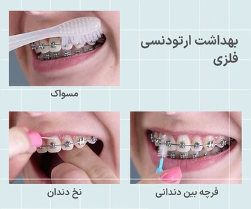 رعایت بهداشت دهان و دندان در طول درمان ارتودنسی فلزی با استفاده از مسواک و نخ دندان مخصوص