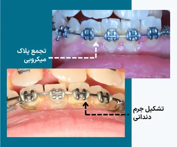 تجمع پلاک میکروبی و تشکیل جرم دندانی اطراف براکت ها