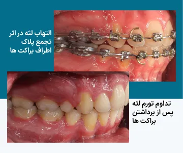 التهاب و تورم لثه در اثر تجمع پلاک اطراف براکت ها