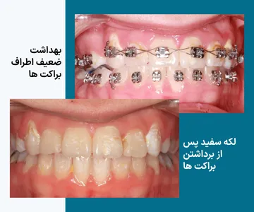 بهداشت ضعیف اطراف براکت ها و لکه سفید باقی مانده پس از برداشتن آن ها