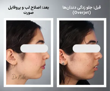 مقایسه نیمرخ صورت قبل و بعد از ارتودنسی با کاهش جلو زدگی دندان ها و بهبود فرم لب ها