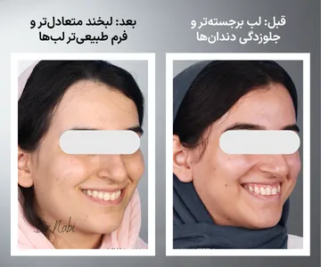  مقایسه قبل و بعد فرم لبخند پس از ارتودنسی؛ پهن تر شدن قوس لبخند، مرتب شدن دندان ها و بهبود زیبایی لبخند