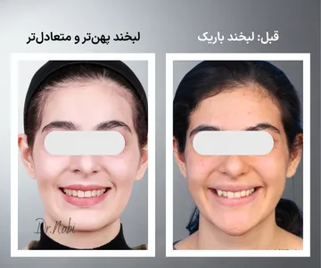 مقایسه قبل و بعد فرم لبخند پس از ارتودنسی؛ پهن تر شدن قوس لبخند، مرتب شدن دندان ها و بهبود زیبایی لبخند
