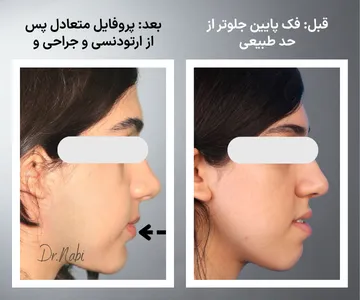 مقایسه نیم رخ قبل و بعد جراحی فک و ارتودنسی در بیمار دارای جلو بودن فک پایین (آندربایت) با بهبود پروفایل و هماهنگی صورت
