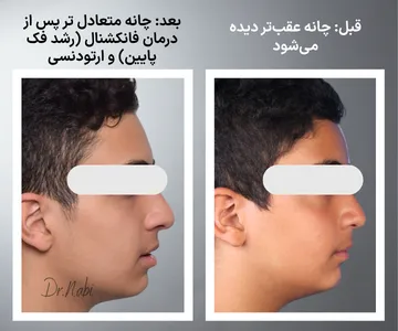 مقایسه قبل و بعد درمان فانکشنال و ارتودنسی در بیمار دارای عقب بودن فک پایین؛ بهبود رشد فک پایین و متعادل تر دیده شدن چانه و پروفایل نیم رخ صورت