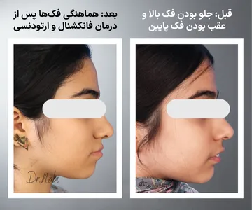 مقایسه قبل و بعد درمان فانکشنال و ارتودنسی در بیمار دارای جلو بودن فک بالا و عقب بودن فک پایین با بهبود رابطه فک ها، پروفایل صورت و اکلوژن