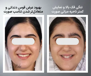 مقایسه قبل و بعد درمان ارتودنسی همراه با گسترش فک بالا (پالیتال اکسپنشن) در بیمار دارای تنگی فک بالا؛ بهبود عرض قوس دندانی و تغییر ادراک ناحیه میانی صورت و گونه ها بدون تغییر استخوان زیگوماتیک