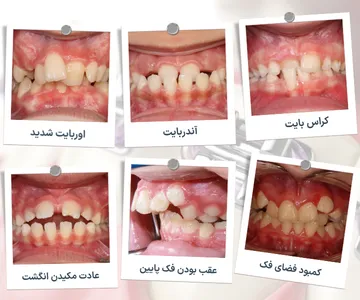 کلاژ ناهنجاری های دندانی و فکی شامل کراس بایت، آندربایت، اوربایت، کمبود فضای دندان، عقب بودن فک پایین و اپن بایت ناشی از مکیدن انگشت در کودکان