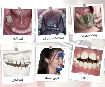 کلاژ دستگاه های ارتودنسی پیشگیرانه شامل پلاک متحرک، دستگاه گسترش فک، فضا نگهدار، تانگارد، فیس ماسک و دستگاه فانکشنال برای درمان ناهنجاری های دندانی و فکی کودکان