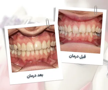 مقایسه قبل و بعد درمان ارتودنسی در بیمار 35 ساله با نامرتبی متوسط دندان ها و اصلاح خط میانی لبخند
